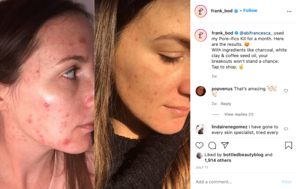 Frank-Body-Before-And-After-Result-Post